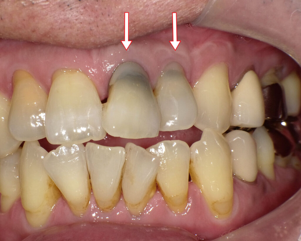 上顎1番と2番の歯が黒く変色