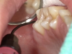シーラントを歯の溝に填入