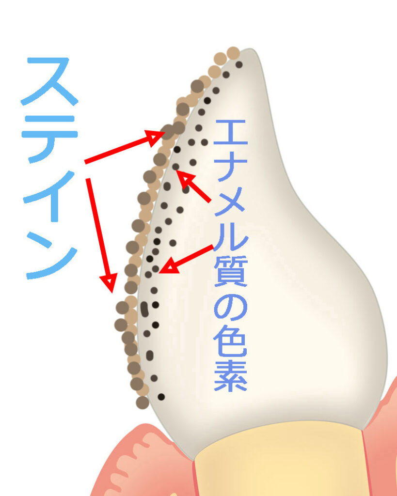 歯の黄ばみの本質