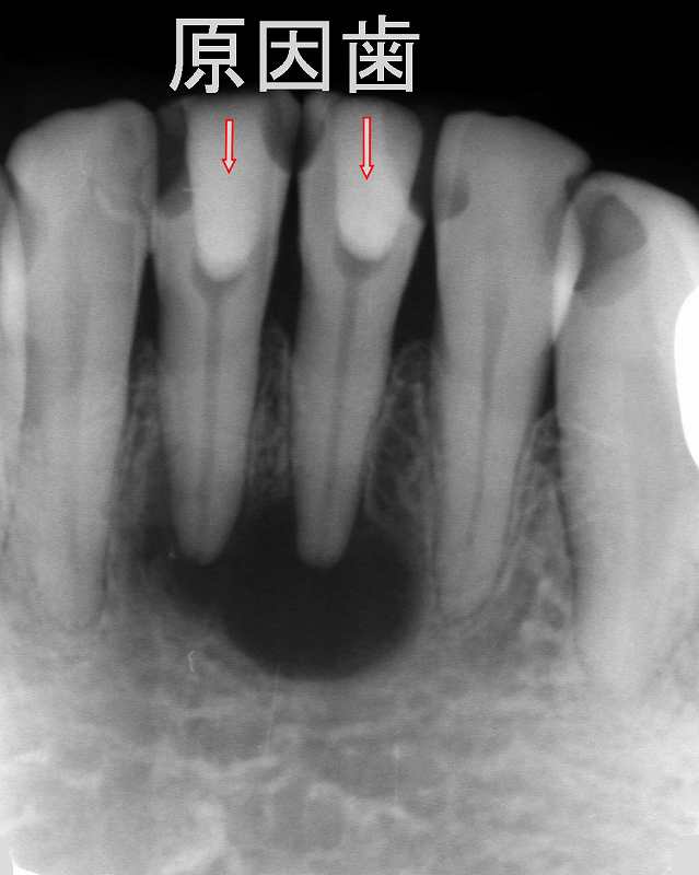 下顎の前歯の大きな歯根嚢胞