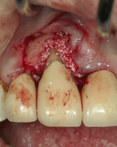 歯周病のフラップ手術に応用