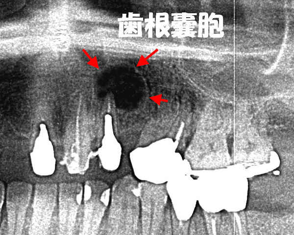 上顎前歯（２番）が原因の大きい歯根嚢胞
