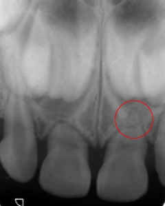 同症例の乳歯根先端が折れたレントゲン写真