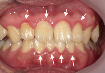歯周病や歯肉炎で歯茎が赤色～薄紫色に変色