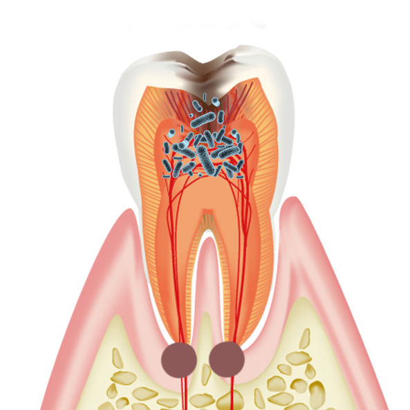 中程度の歯根嚢胞