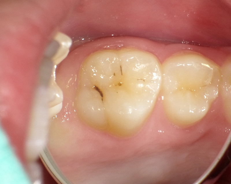 子供の第１大臼歯に出来た初期虫歯