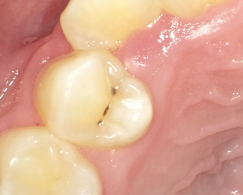 子供の小臼歯に出来た初期虫歯