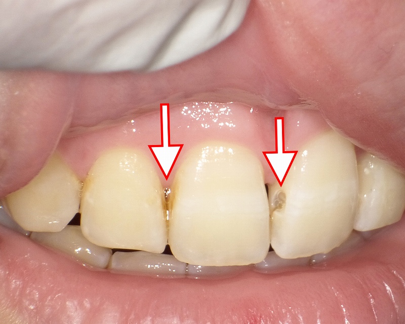 小学生の子供の前歯に出来た初期虫歯
