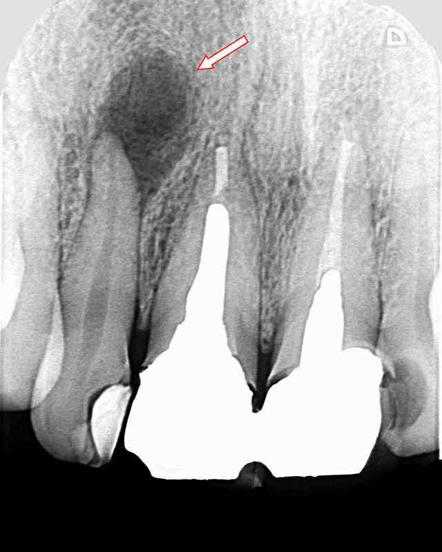 上顎側切歯の歯根嚢胞