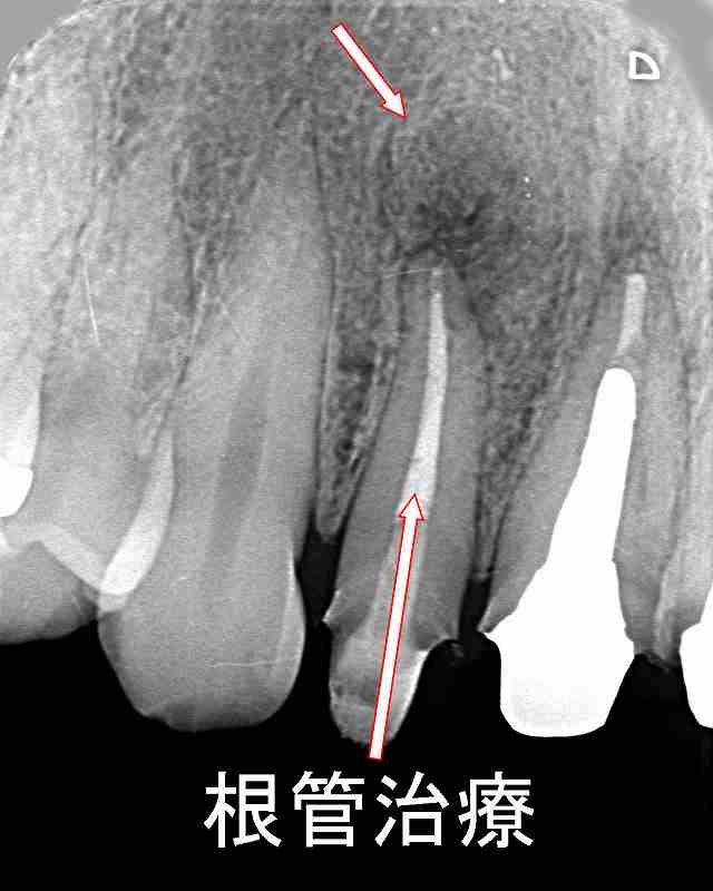 歯根嚢胞が治癒