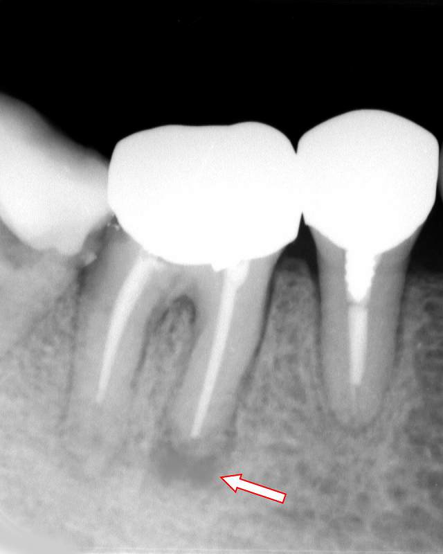 根管治療後の歯根嚢胞