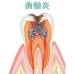 歯髄炎の激痛対策と治療法