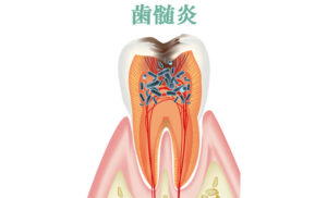 歯髄炎の激痛対策と治療法