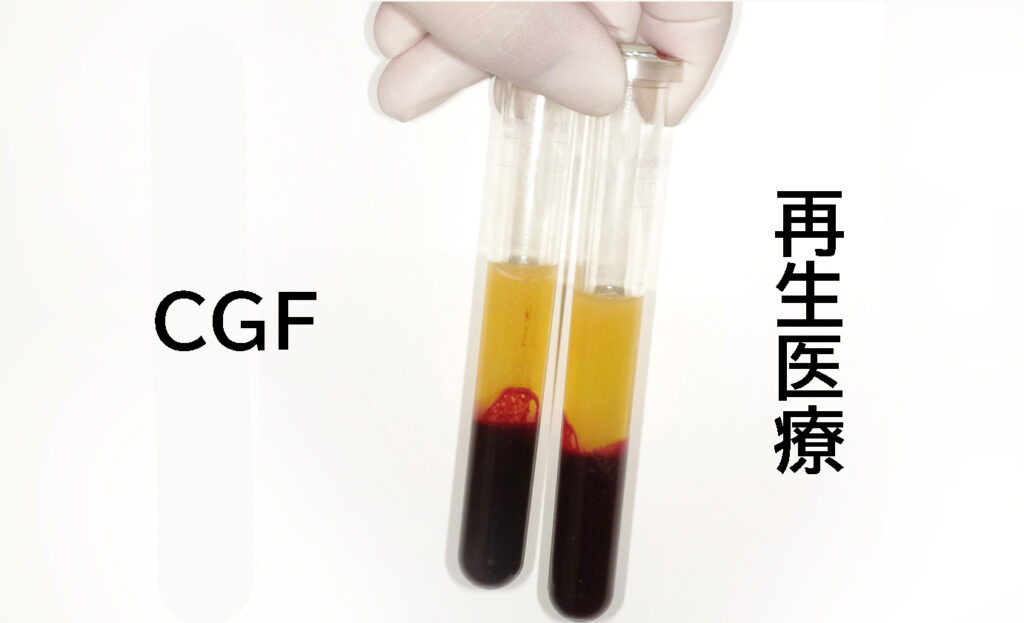 CGF再生療法とは？インプラントや歯周病に役立つ最新歯科治療を