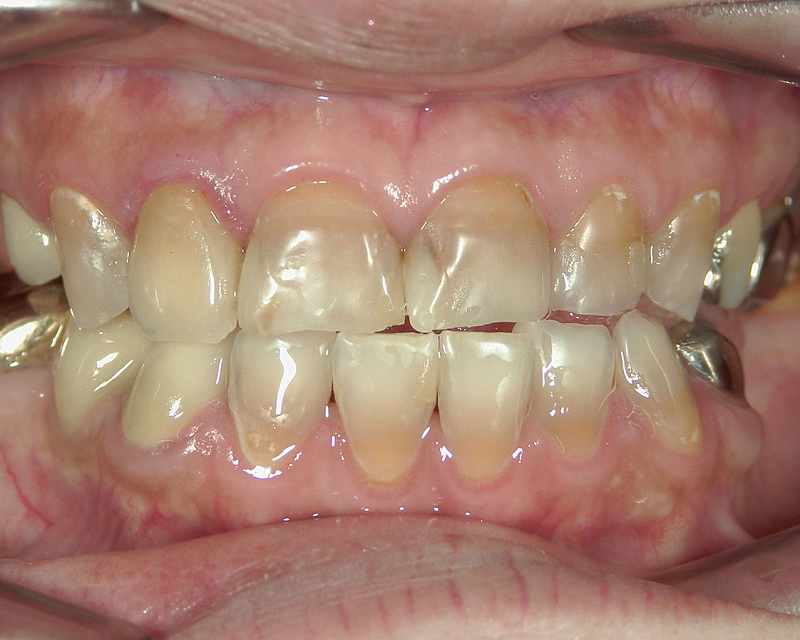 歯頸部が変色したテトラサイクリン歯