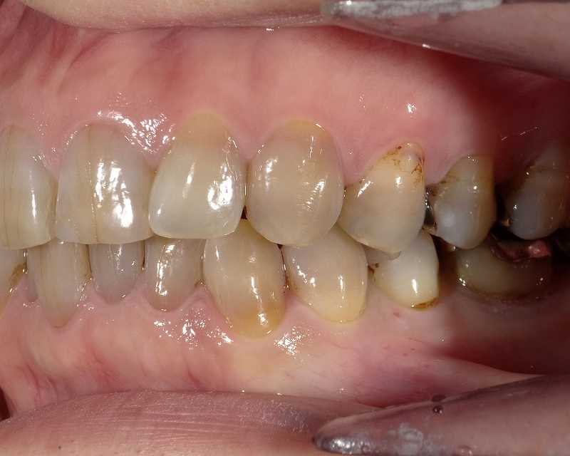 重度のテトラサイクリン歯