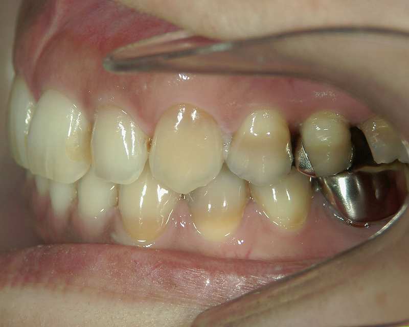 前歯にテトラサイクリン歯は認められず
