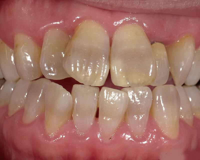 歯の中央部に褐色ラインがあるテトラサイクリン歯