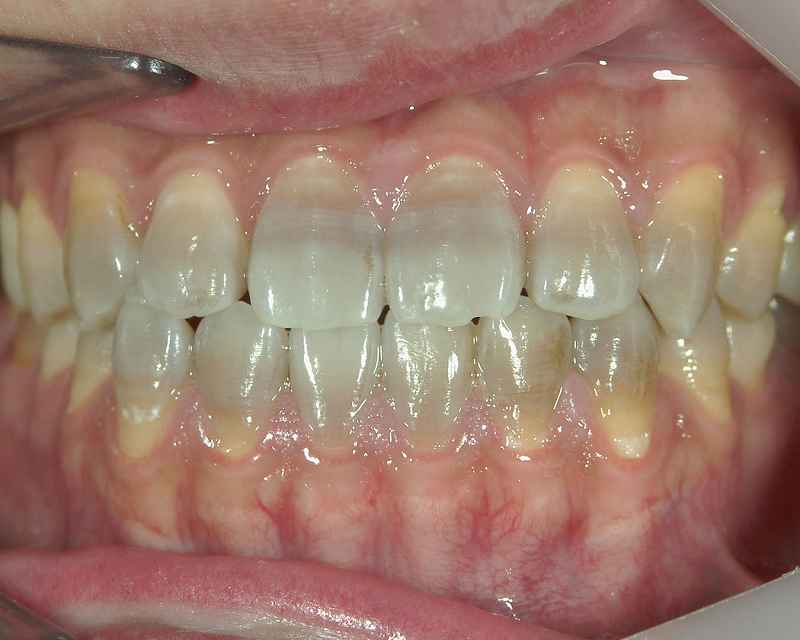 テトラサイクリン変色歯