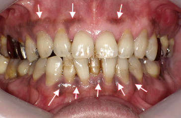 長期間の喫煙が原因のい歯茎の黒ずみ