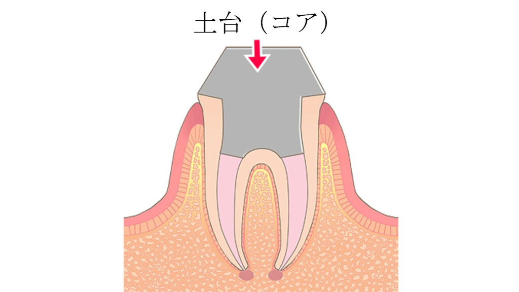 支台（コア）