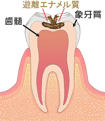 虫歯C2の遊離エナメル質
