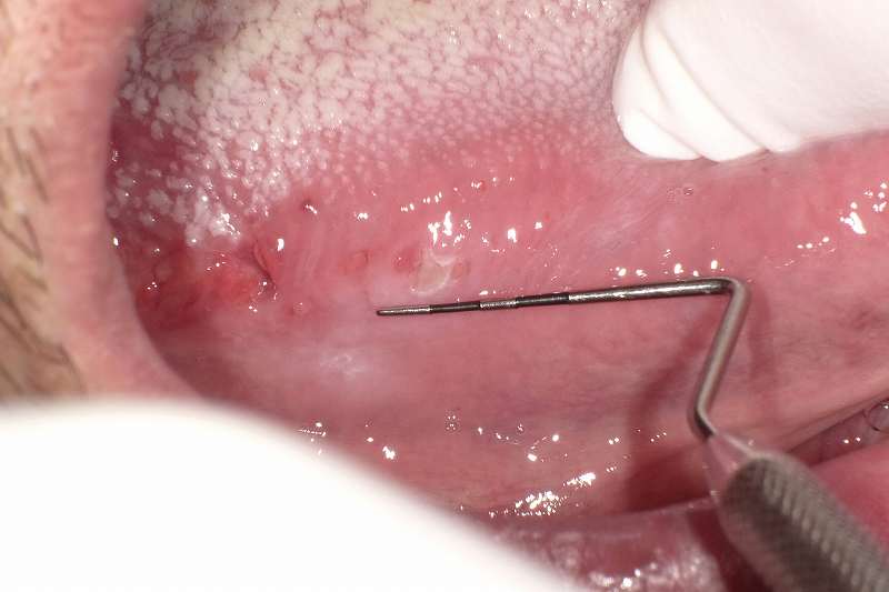 舌の側面のびらん状の粘膜病変