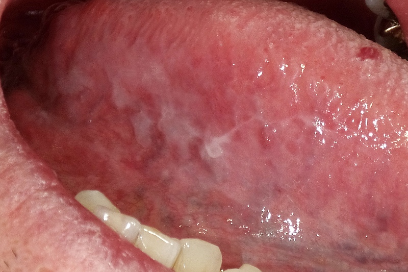 舌の裏側に出来た扁平苔癬