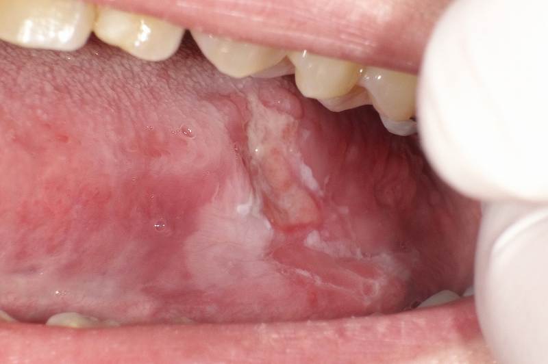 舌の側面にできた潰瘍状のできもの