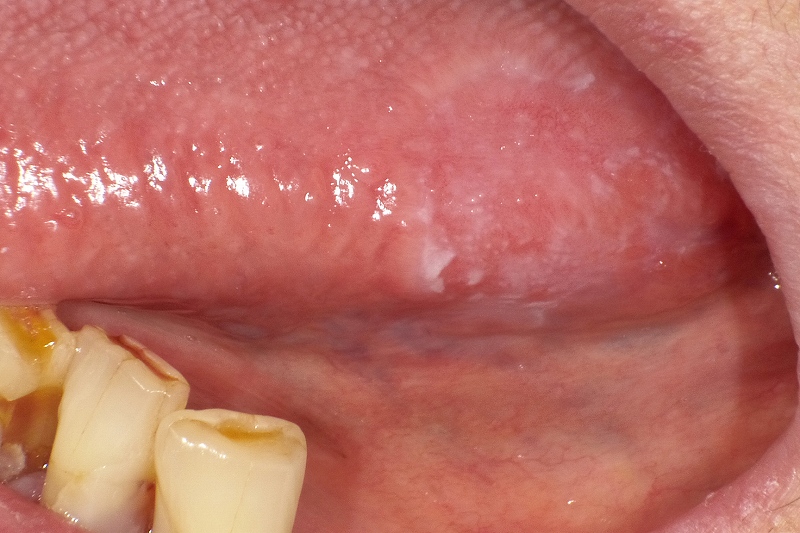 舌の側面に出来た扁平苔癬