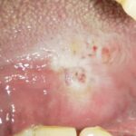 【画像】初期舌癌・口内炎の見分け方