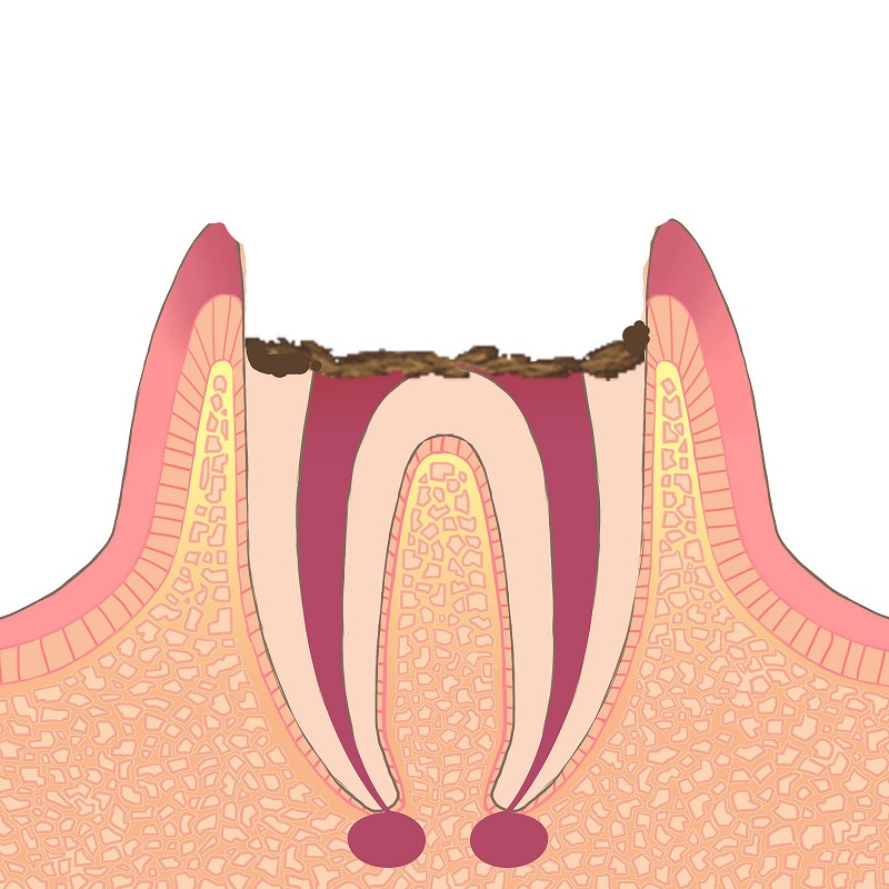 虫歯の進行度合いC4の模式図