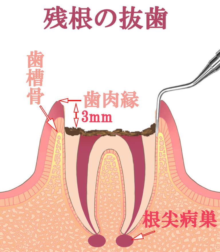 残根保存か抜歯かの基本方針