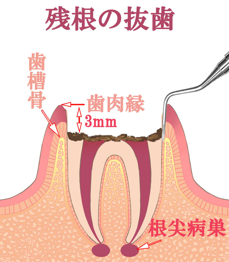 残根の保存か抜歯の境界