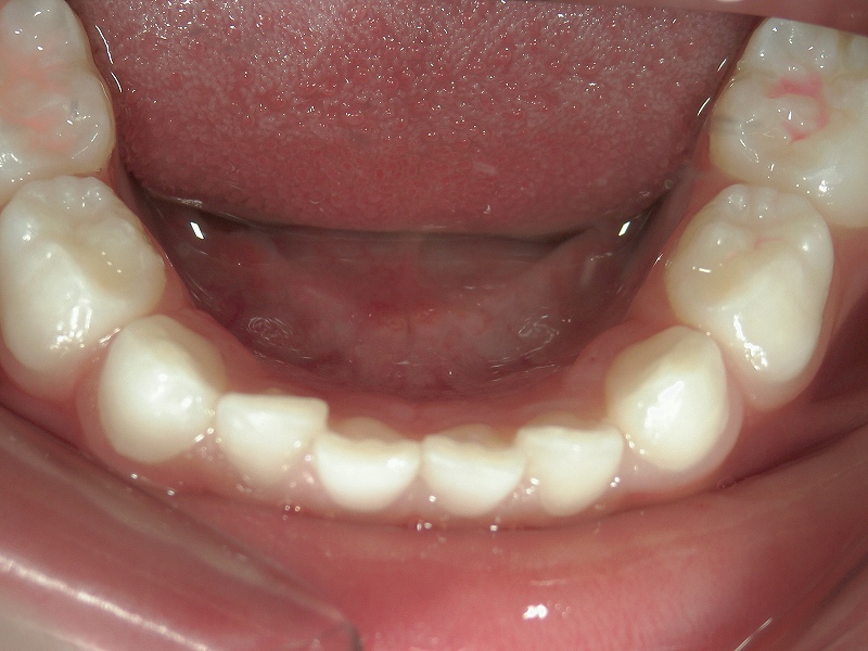 歯の隙間が全くない下顎乳歯列