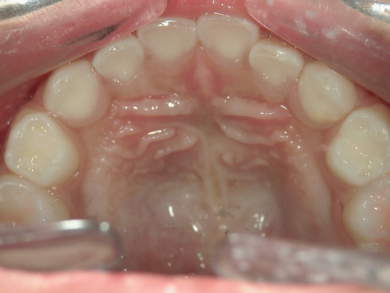 歯の隙間が全くない上顎乳歯列
