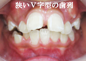 アデノイド顔貌の正面 歯並びは出っ歯