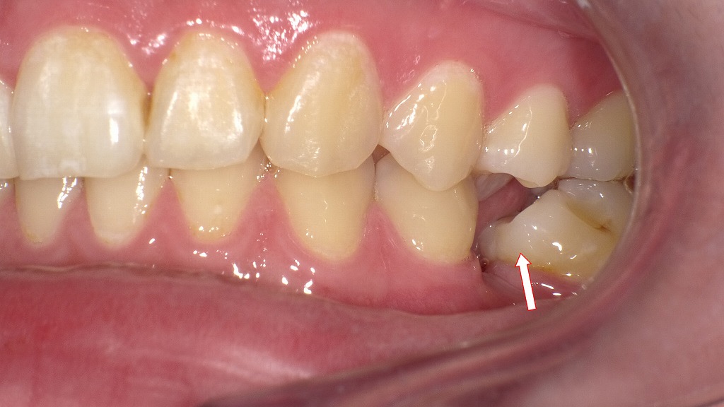 奥歯を抜歯後放置