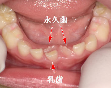 ２本の下顎中切歯が内側から生える