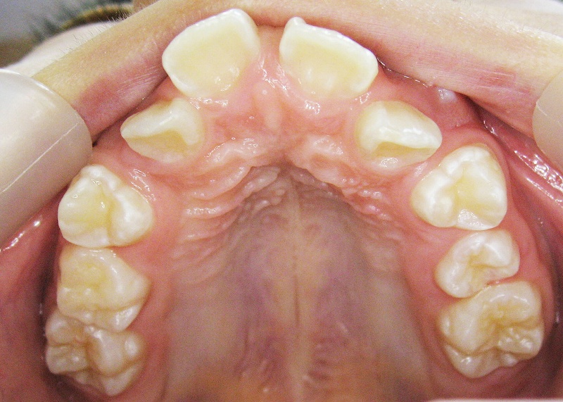 出っ歯で開咬の症例
