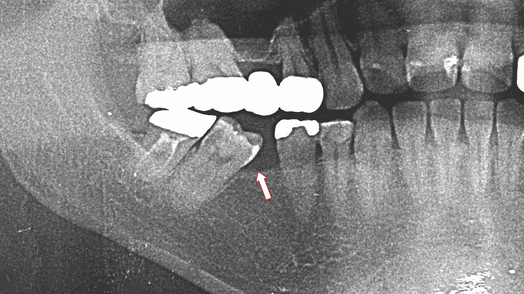 右下６番抜歯後放置（レントゲン写真）