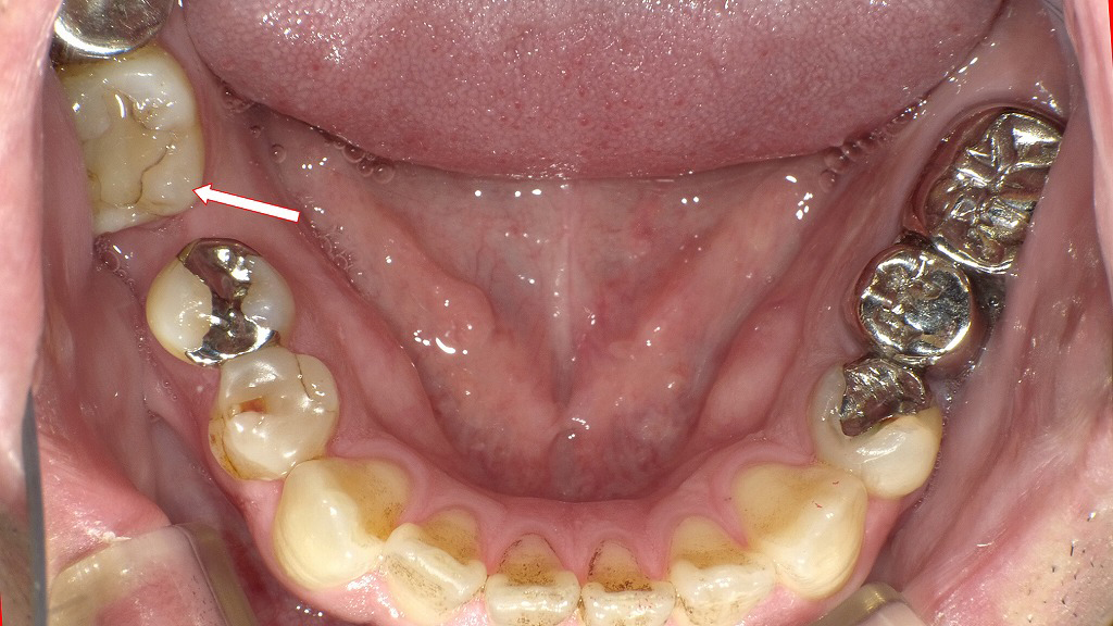 右下６番抜歯後放置（咬合面観）