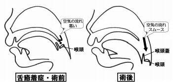 舌癒着症の術前・術後 日本舌癒着症学会より引用