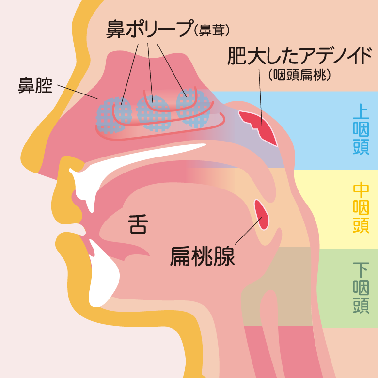 鼻呼吸を妨げるアデノイド（咽頭扁桃）の肥大、鼻ポリープ（鼻茸）の模式図