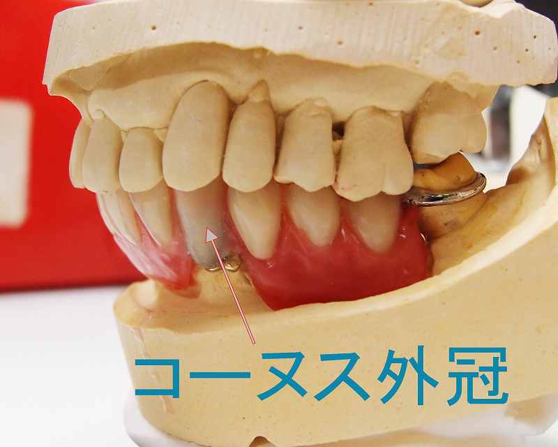 コーヌステレスコープ義歯の完成