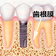インプラントと天然歯との違い