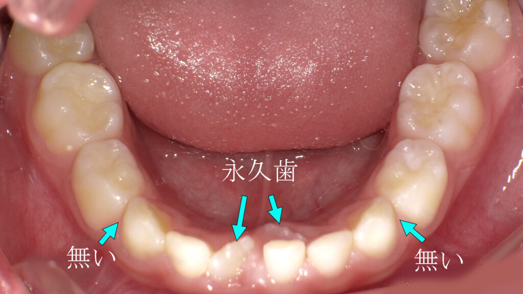 霊長空隙がないため永久歯が内側から生えてきた