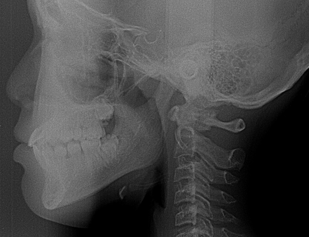 セファロレントゲンによる骨格分析