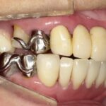 保険適用の目立たない部分入れ歯は作れる？
