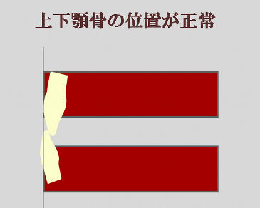 歯の傾きや位置が原因で受け口